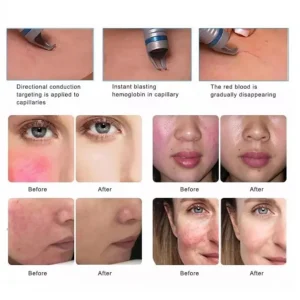 Aparat Dioda Laser 980nm Indepartare venectazii, Vase capilare sparte, Indepartare Vene panza de paianjen, Venom II 30W